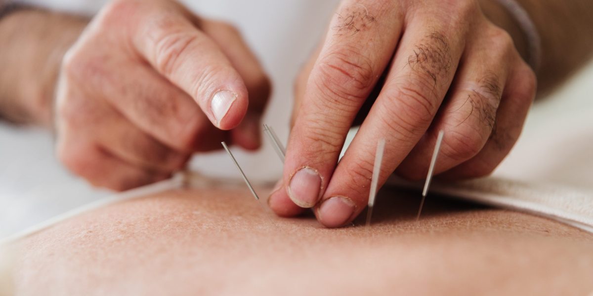 Acupuncture @ BodyMed Clontarf